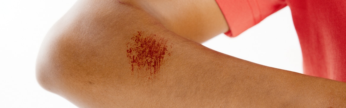 Vrouw verzorgt haar schram met een Leukomed T plus verband van Leukoplast.
