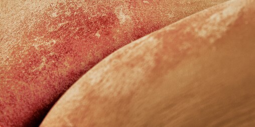 Incontinentie-gerelateerde dermatitis of luieruitslag bij volwassenen met een vochtige, rode huid.