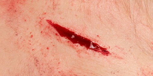 Close-up van voorhoofd of slaap met gapende rijtwond.